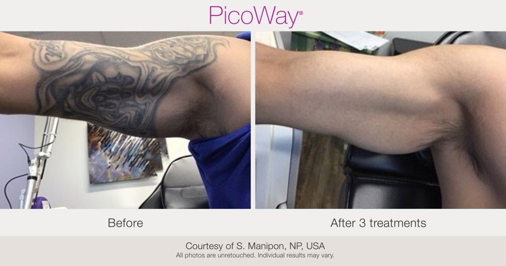 BA-PicoWay-BetterOff-Tattoo-post3tx-01