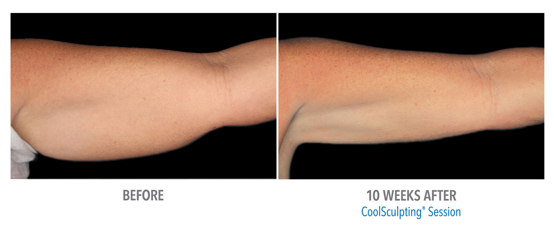 CoolSculpting-Before-After-Female-Arms-1