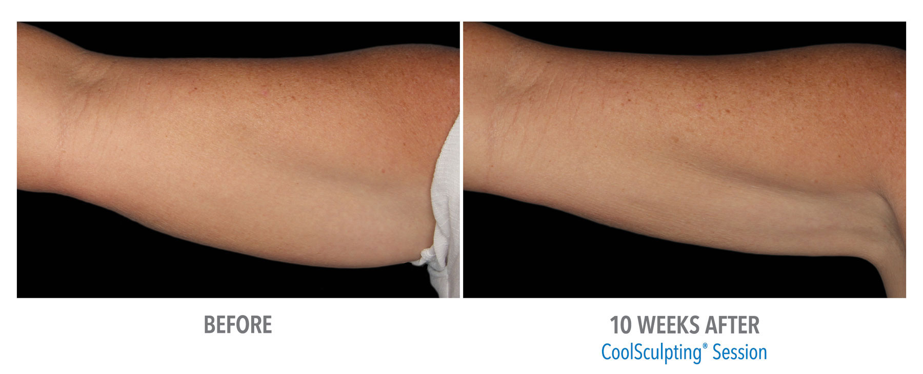 CoolSculpting-Before-After-Female-Arms-2