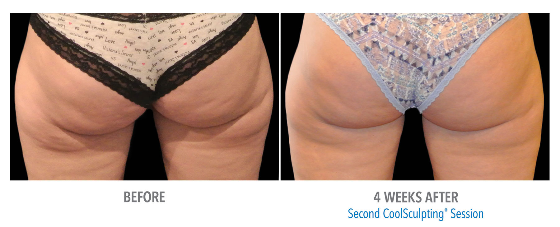 CoolSculpting-Before-After-Female-Banana-Roll-Back-View