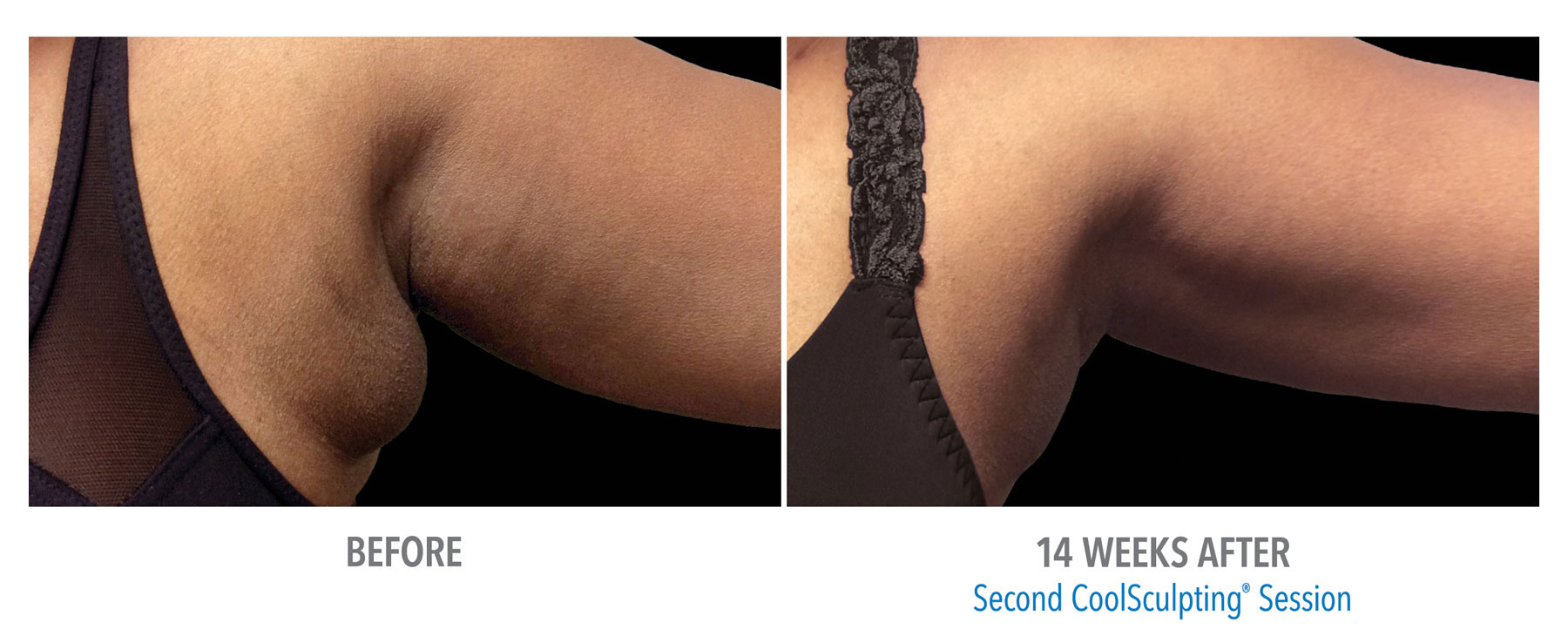 CoolSculpting-Before-After-Female-Bra-Fat-Photo
