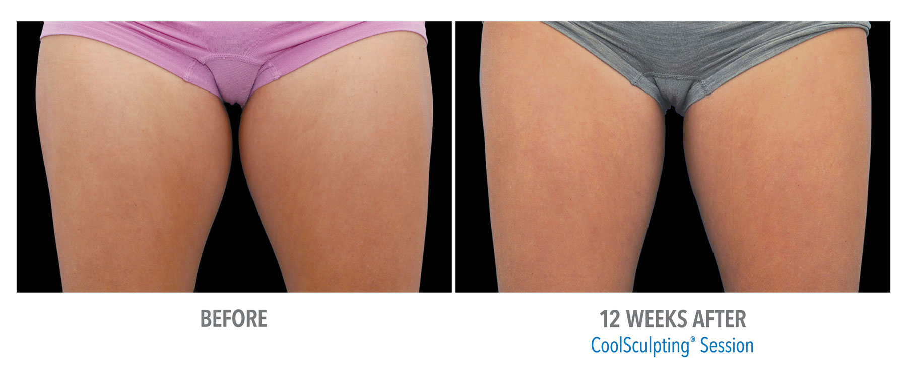 CoolSculpting-Before-After-Female-Inner-Thigh-Front-View-2