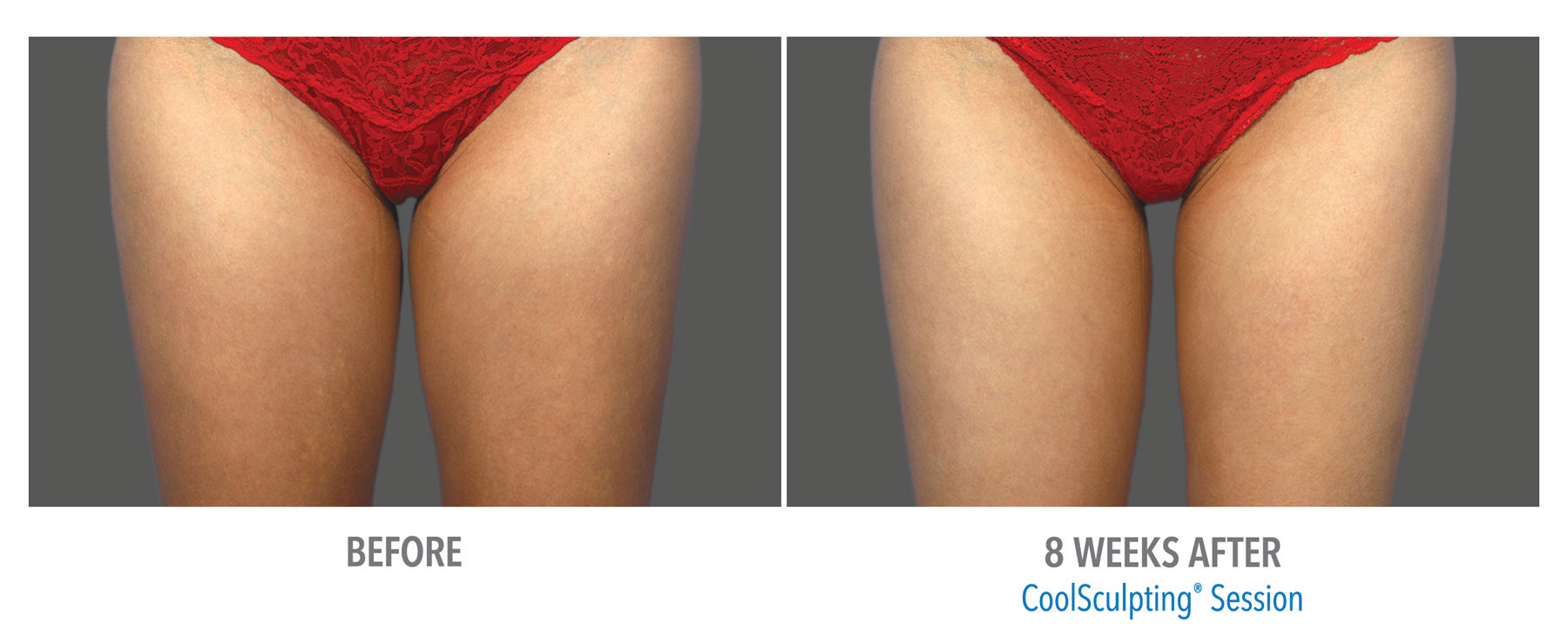 CoolSculpting-Before-After-Female-Inner-Thigh-Front-View