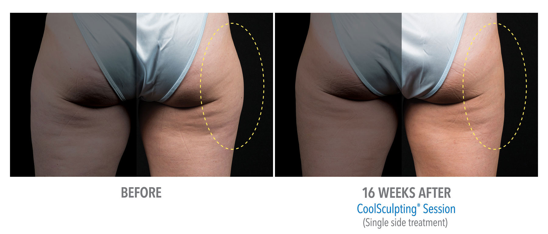 CoolSculpting-Before-After-Female-Outer-Thigh-Back-View