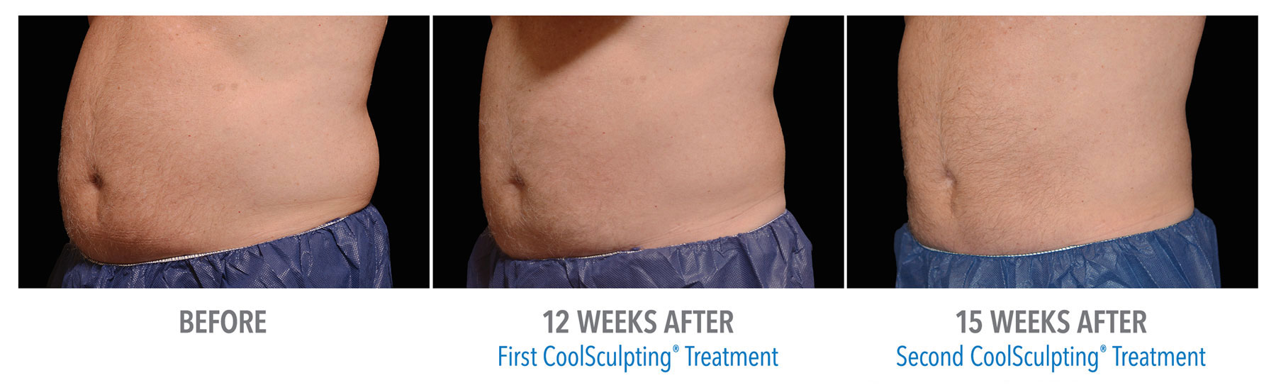 CoolSculpting-Before-After-Male-Abdomen-10