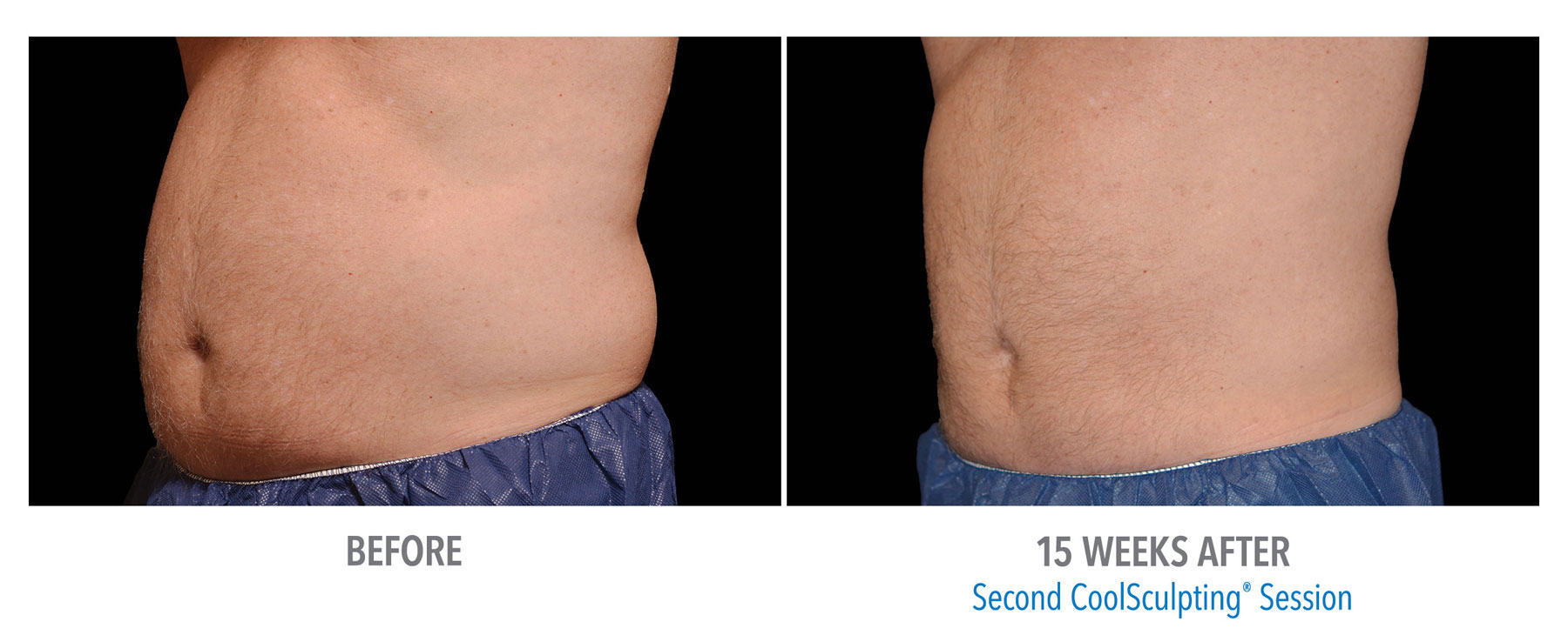 CoolSculpting-Before-After-Male-Abdomen-11