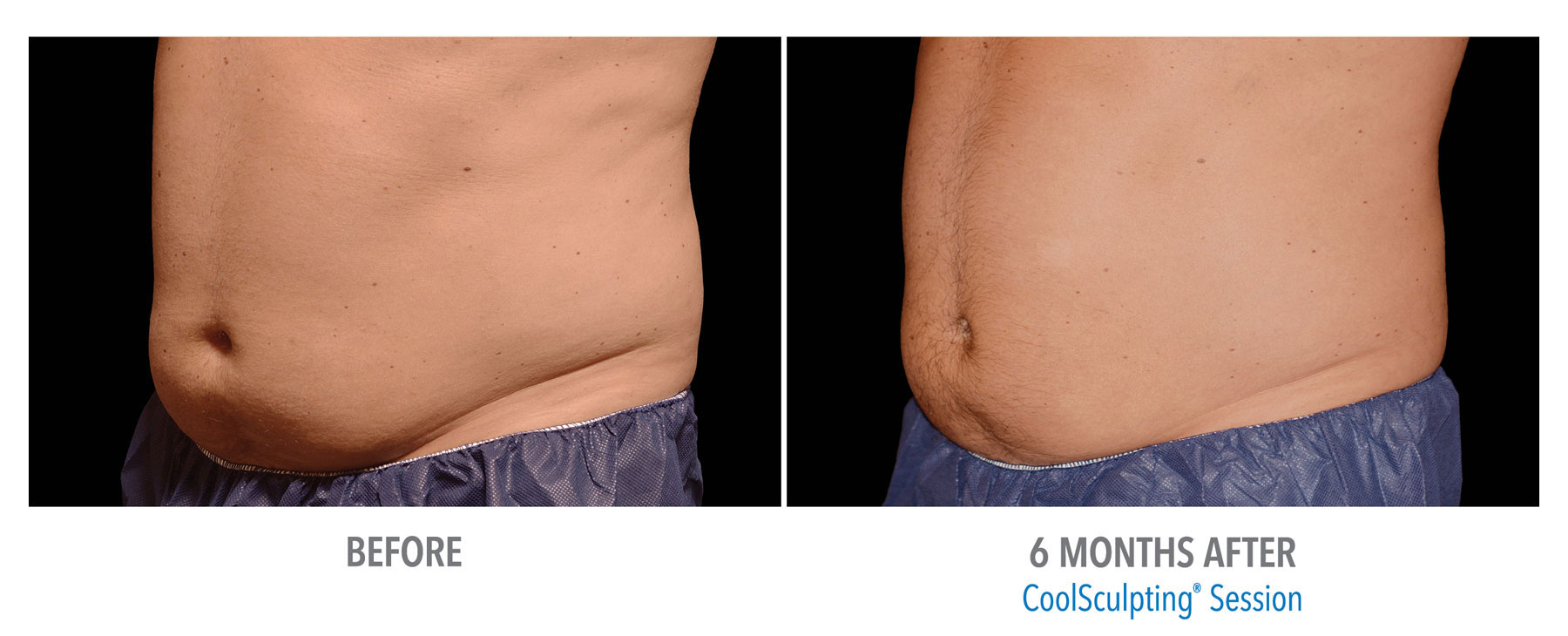 CoolSculpting-Before-After-Male-Abdomen-12