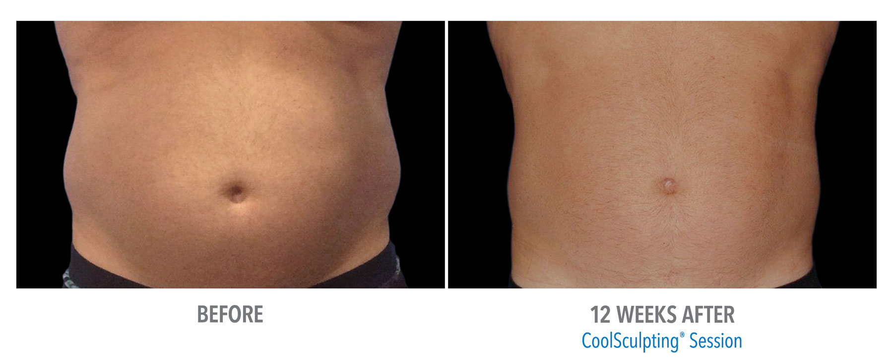 CoolSculpting-Before-After-Male-Abdomen-2