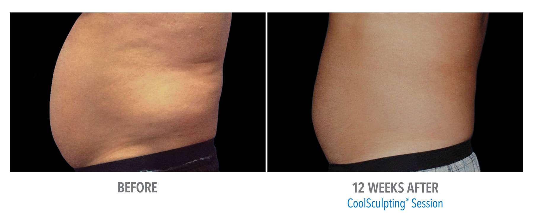 CoolSculpting-Before-After-Male-Abdomen-3