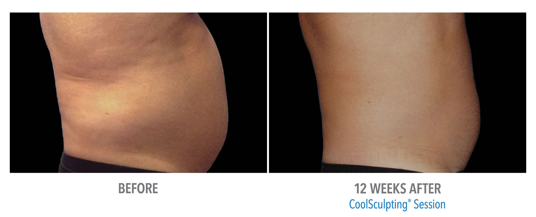 CoolSculpting-Before-After-Male-Abdomen-4