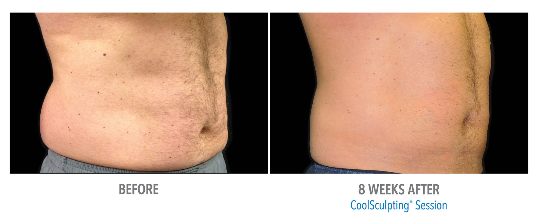 CoolSculpting-Before-After-Male-Abdomen-5