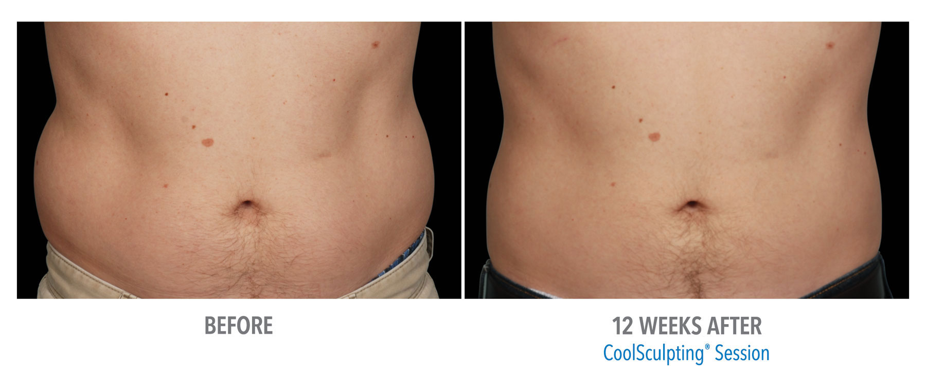 CoolSculpting-Before-After-Male-Abdomen-6