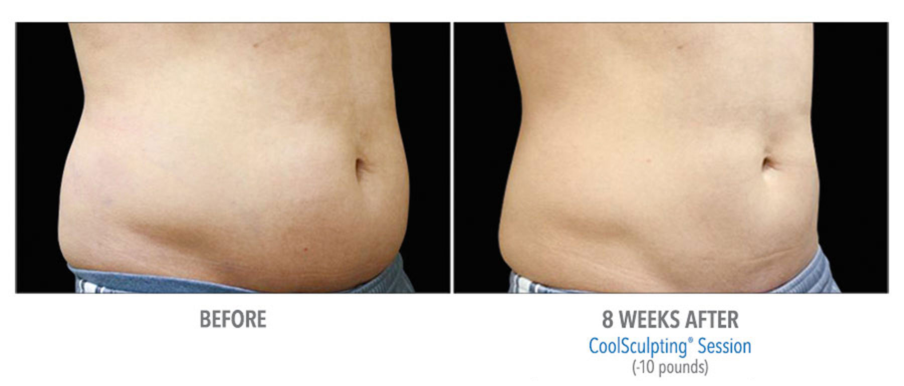 CoolSculpting-Before-After-Male-Abdomen-8