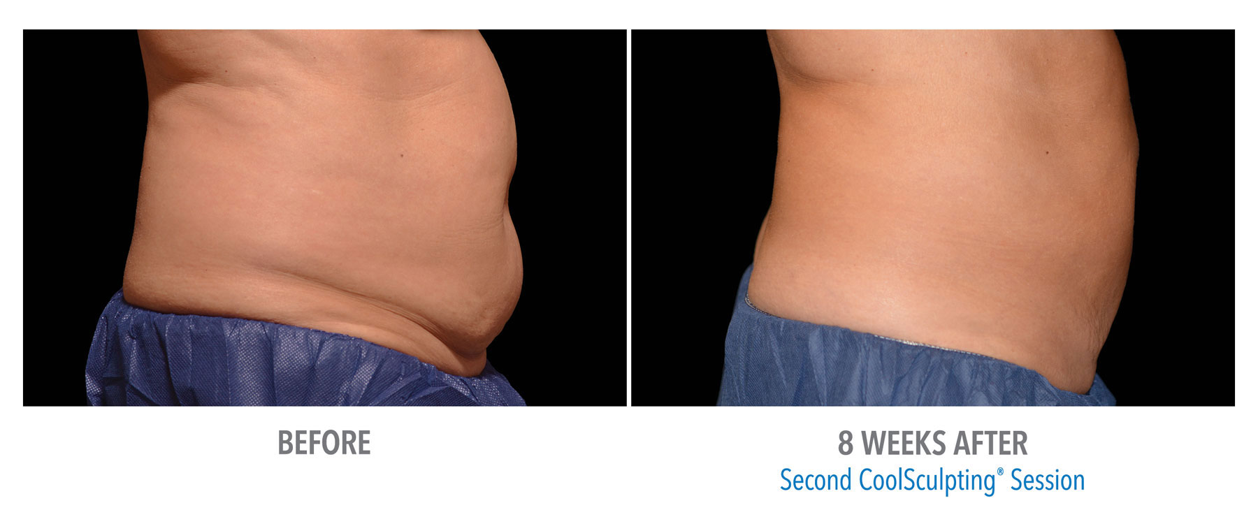CoolSculpting-Before-After-Male-Abdomen-9
