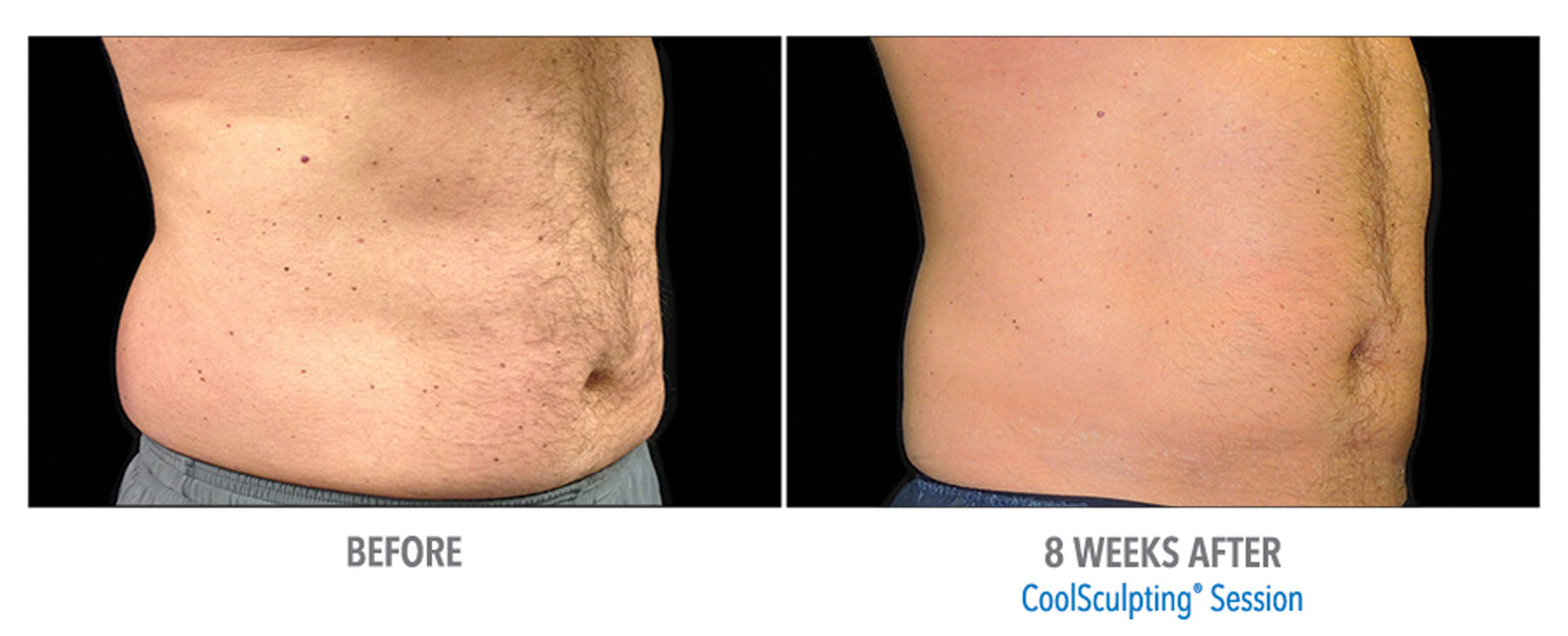 CoolSculpting-Before-After-Male-Abdomen