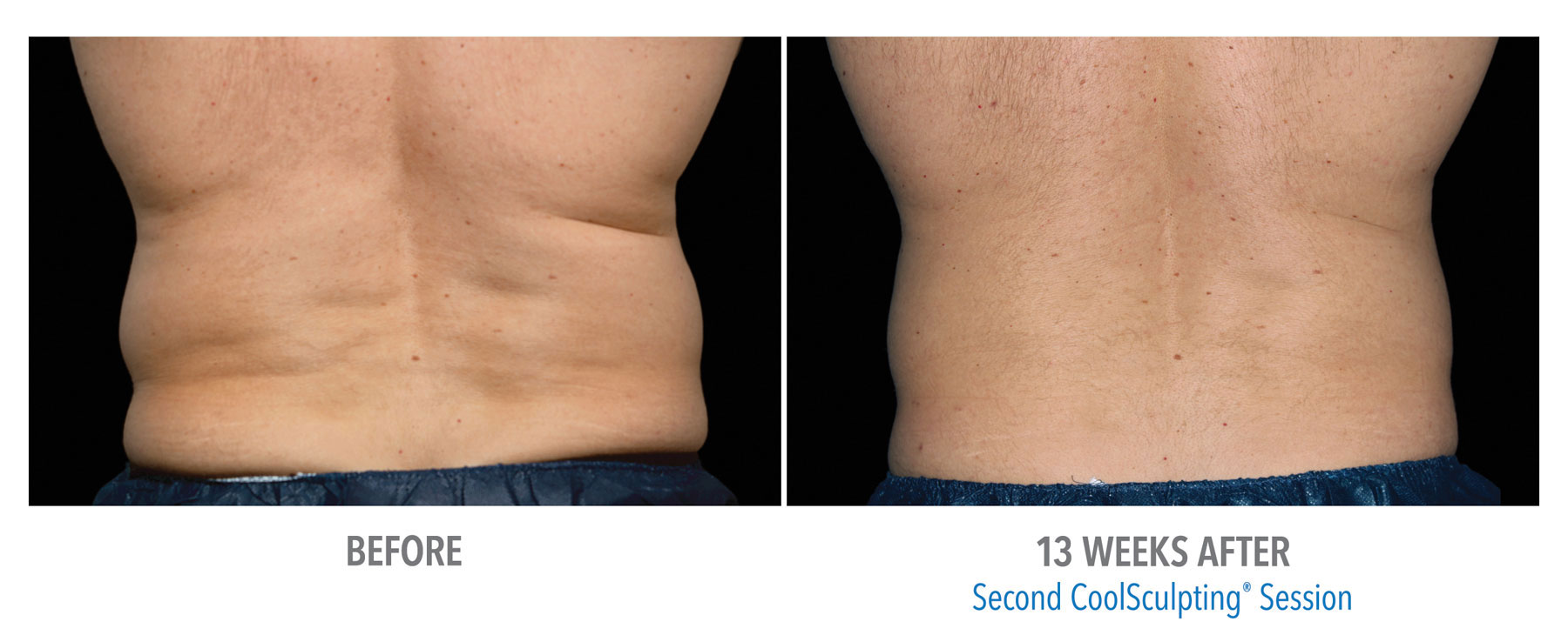 CoolSculpting-Before-After-Male-Flank-Back-View-2