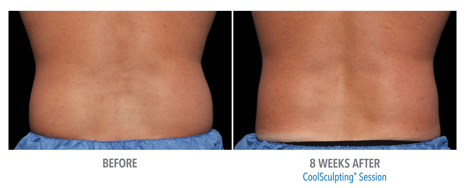 CoolSculpting-Before-After-Male-Flank-Back-View