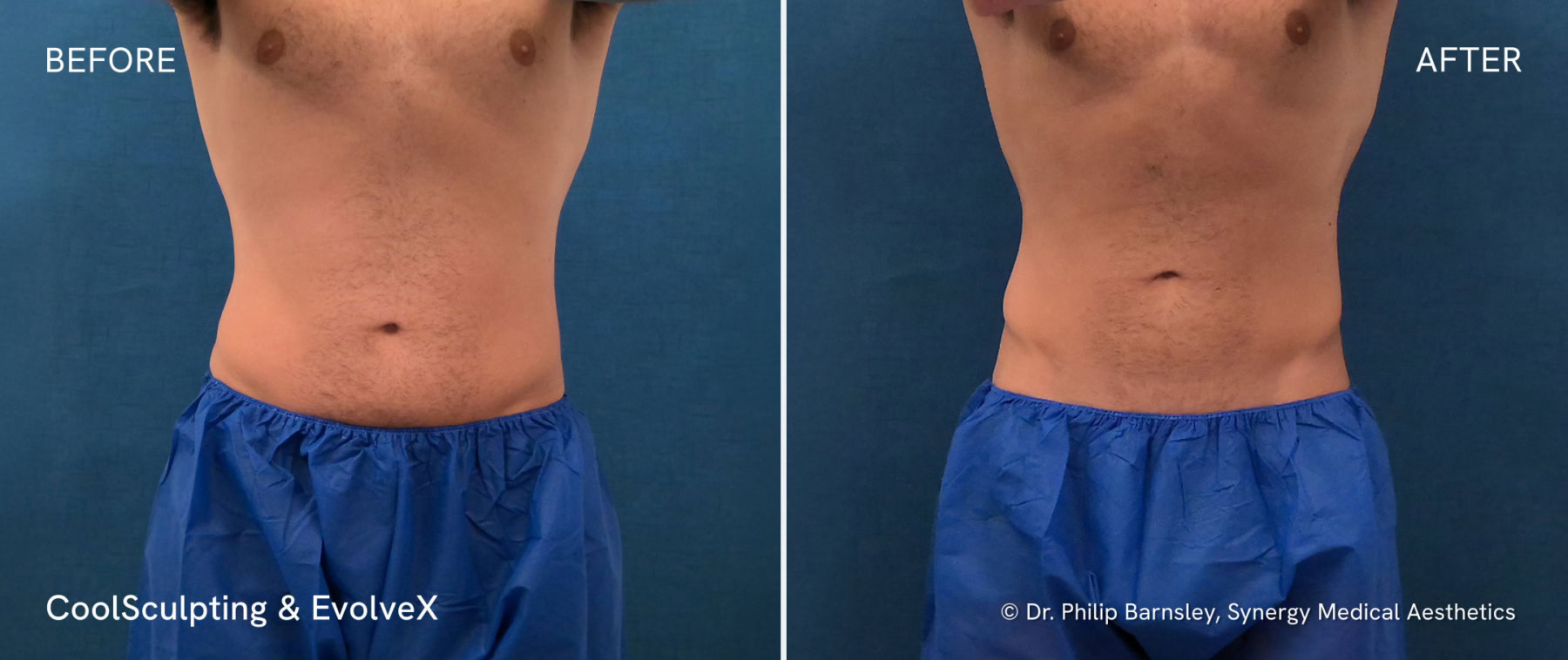 CoolSculpting-EvolveX-Before-After-Nanaimo-front@2x.jpg