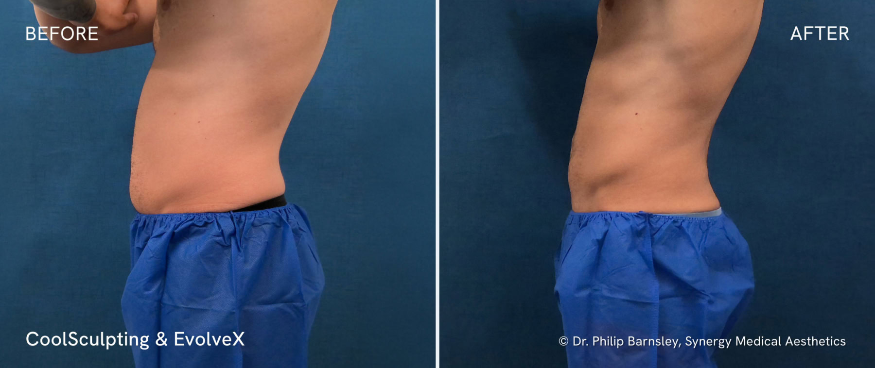 CoolSculpting-EvolveX-Before-After-Nanaimo-side@2x