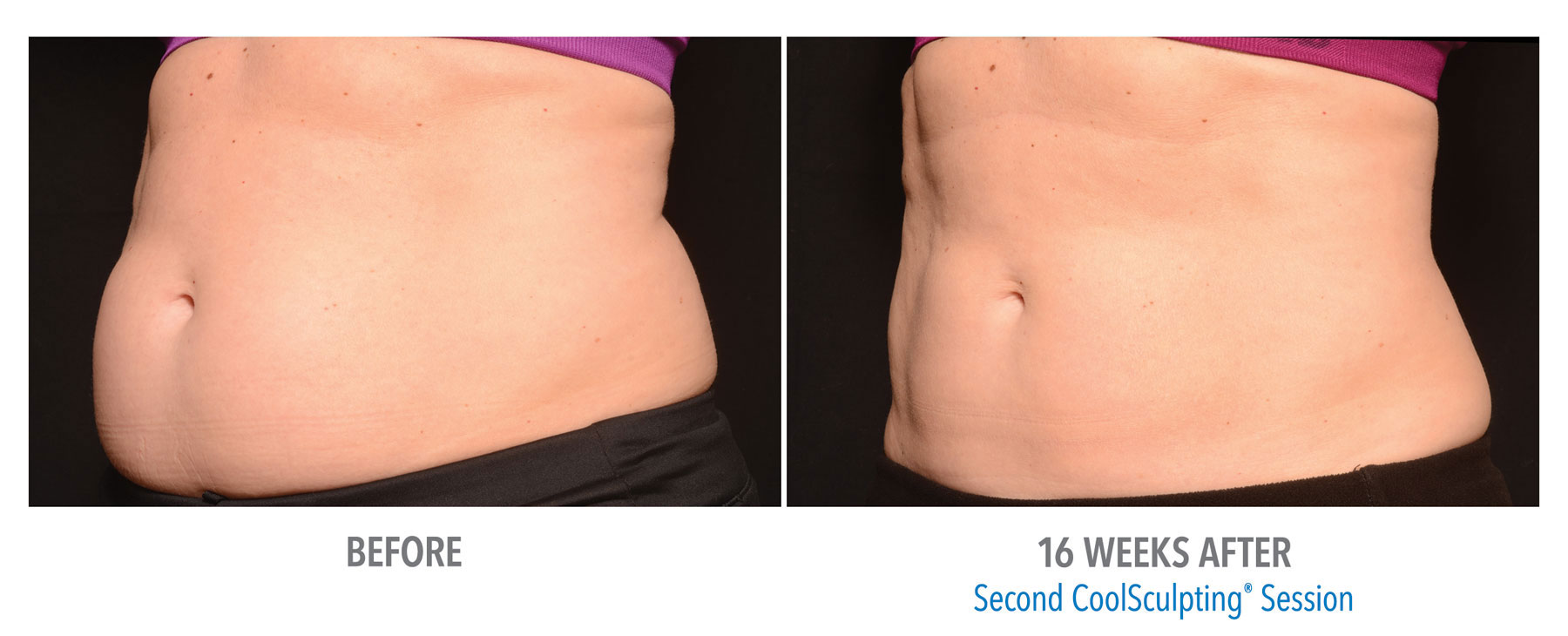 Female-Abdomen-CoolSculpting-Before-After-Nanaimo