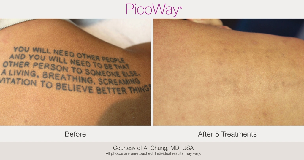 PicoWay-BAs-AChung-Tattoo-post5Tx-18