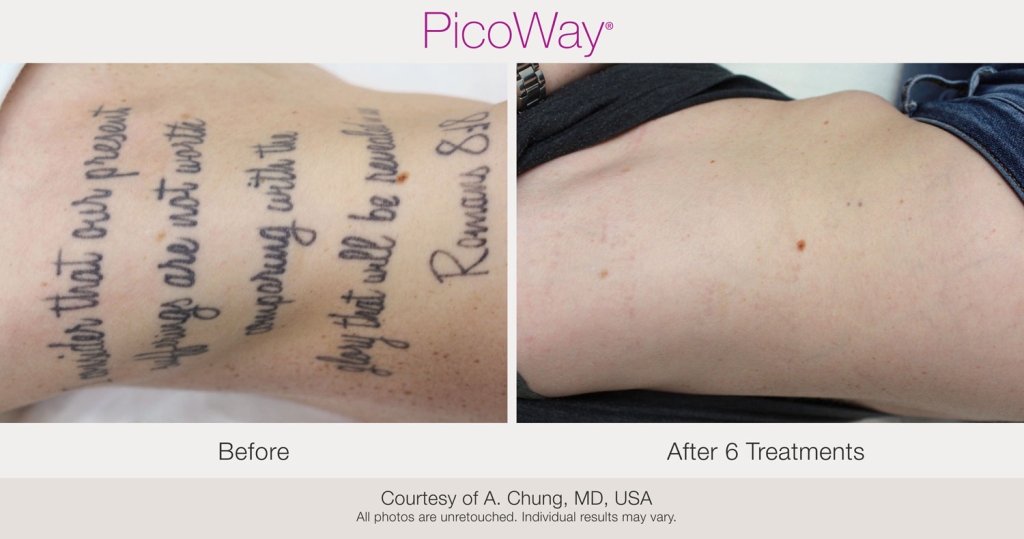 PicoWay-BAs-AChung-Tattoo-post6Tx-19