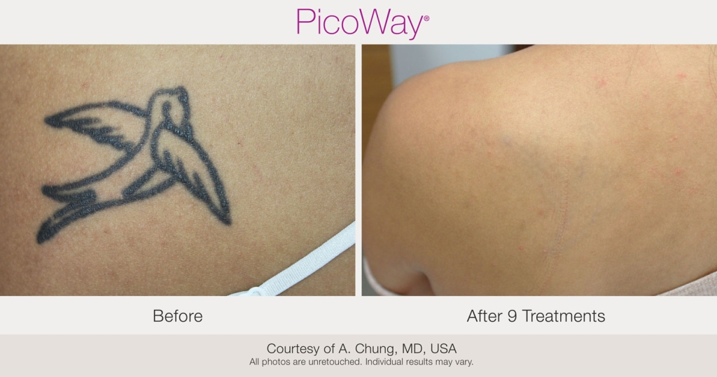 PicoWay-BAs-AChung-Tattoo-post9Tx-17