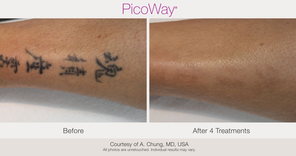 PicoWay_BAs_AChung-Tattoo-post4Tx-15