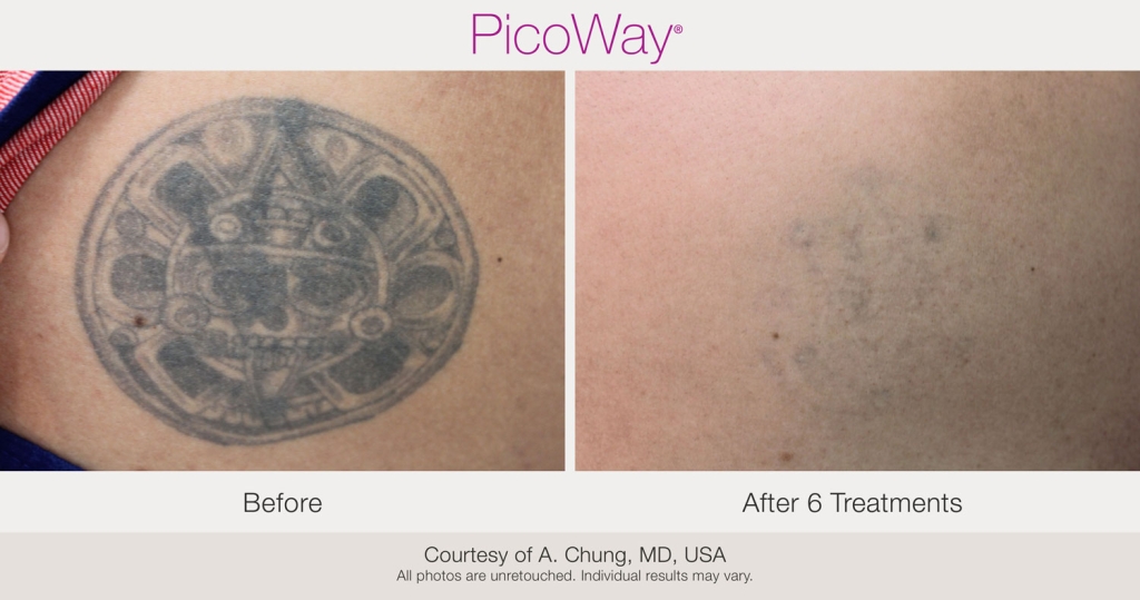 PicoWay_BAs_AChung-Tattoo-post6Tx-14