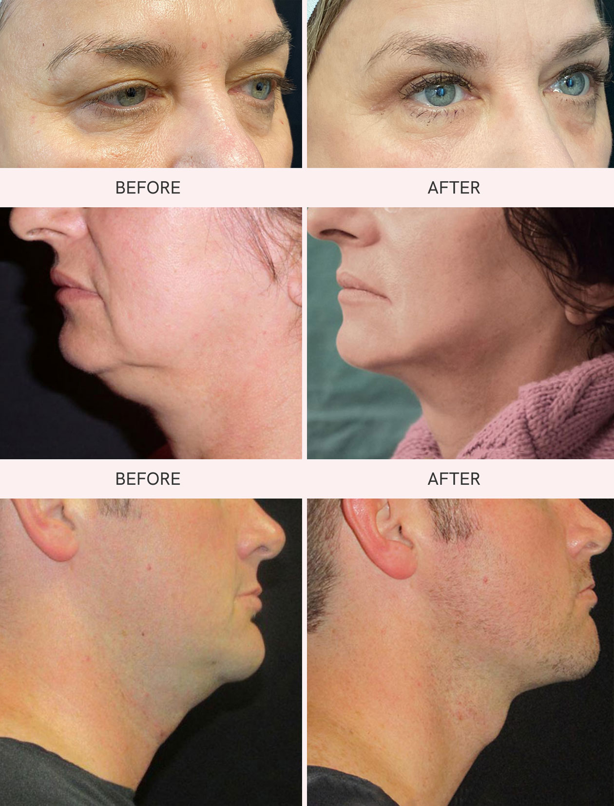 Non-surgical facelift before and after photos