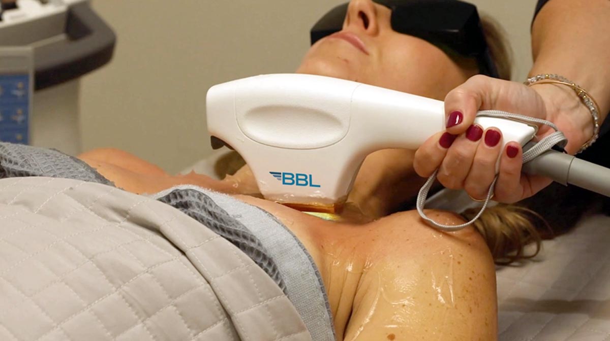 BBL Forever Young Photofacial – Synergy Medical Aesthetics