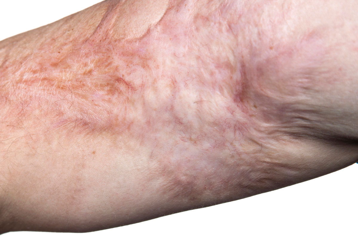 Contracture or burn scar treatment in Nanaimo, BC