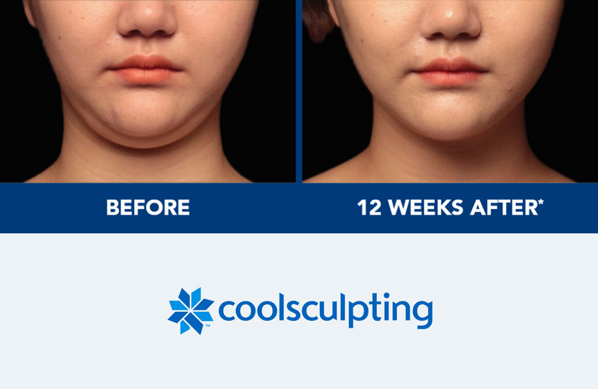 CoolSculpting for Double-Chin Treatment