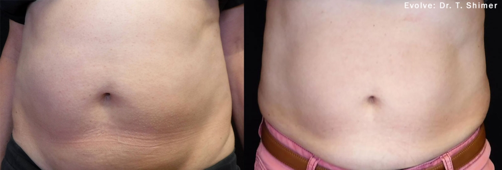 Tummy Tuck (Abdominoplasty) – Synergy Medical Aesthetics – Nanaimo