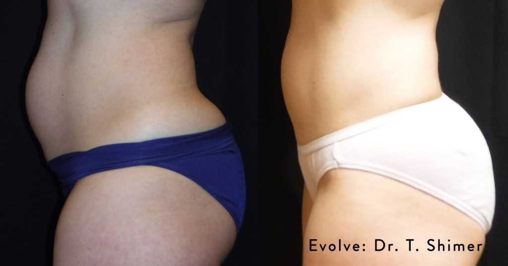 evolvex-before-after-2