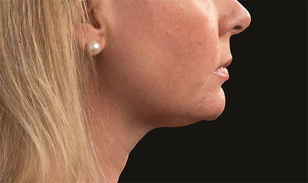 CoolSculpting Chin, Double Chin & Neck Fat Reduction