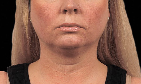 Coolsculpting for Double Chin, Coolsculpting for Neck