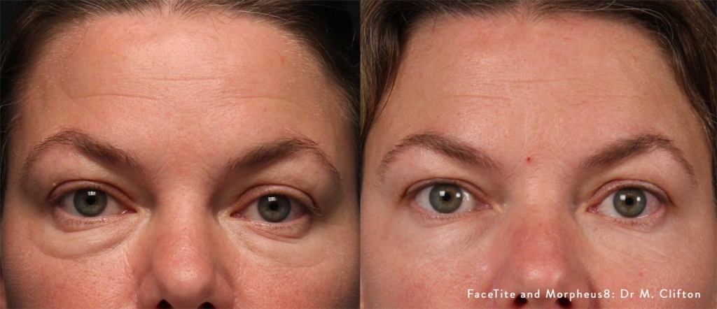 facetite-and-morpheus8-before-after-dr-m-clifton-preview-1