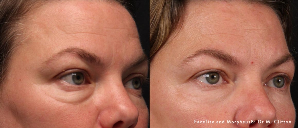 facetite-and-morpheus8-before-after-dr-m-clifton-preview-4
