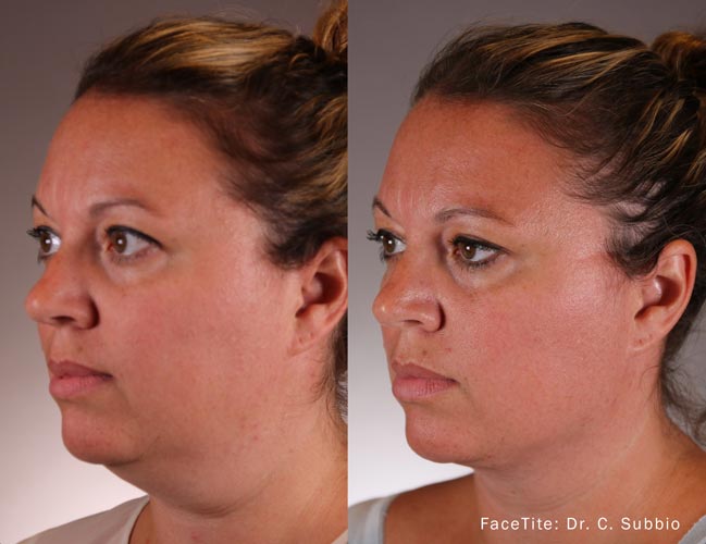 facetite-before-after-dr-c-subbio-preview-1