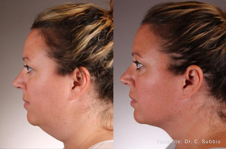 facetite-before-after-dr-c-subbio-preview-2