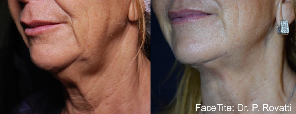 facetite-before-after-dr-p-rovatti-preview-14