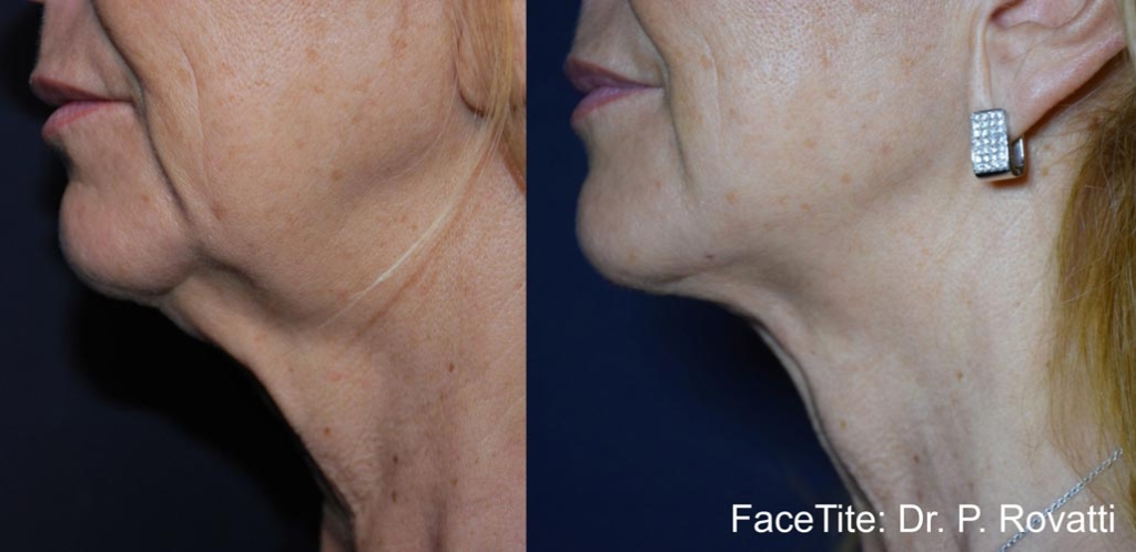 facetite-before-after-dr-p-rovatti-preview-16