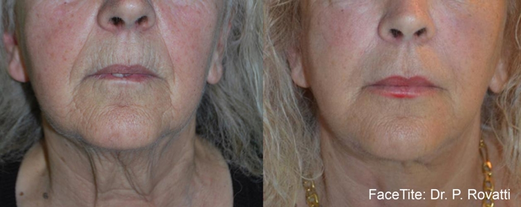 facetite-before-after-dr-p-rovatti-preview-17