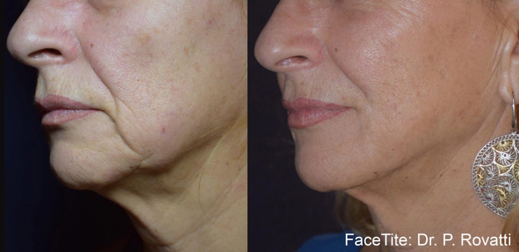 facetite-before-after-dr-p-rovatti-preview-2