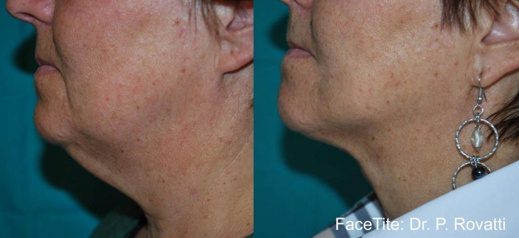 facetite-before-after-dr-p-rovatti-preview-4