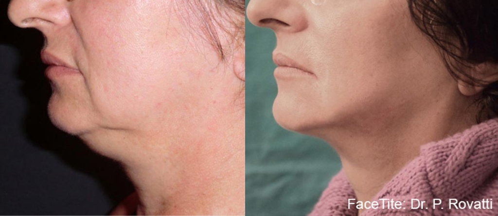 facetite-before-after-dr-p-rovatti-preview-6