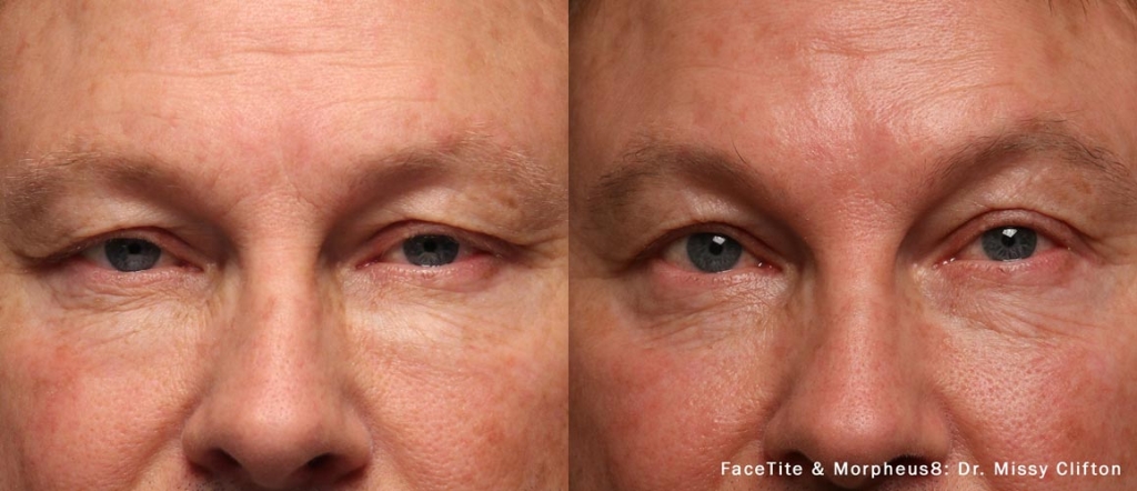 facetite-morpheus8-before-after-dr-m-clifton-preview-3