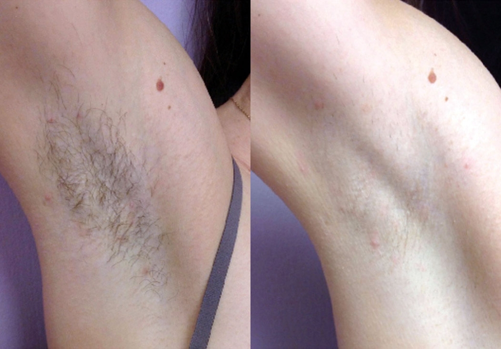 4 moths post 3 Forever Bare BBL Treatments (Elizabeth Hagberg, MD)