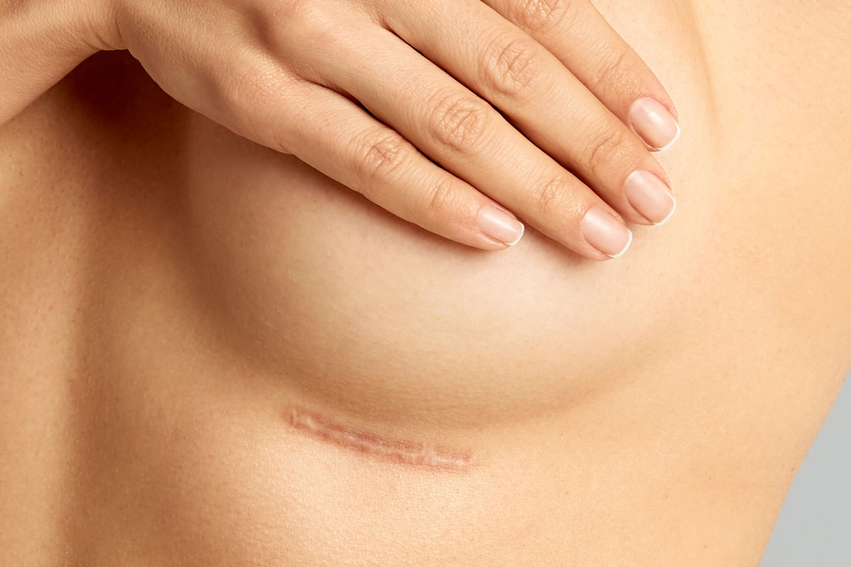 Hypertrophic scar treatment in Nanaimo, BC